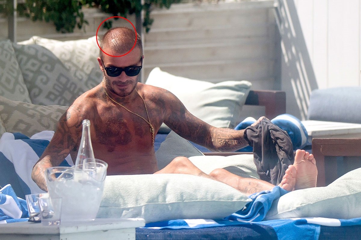 'Beckham saç ektirdi' iddiası